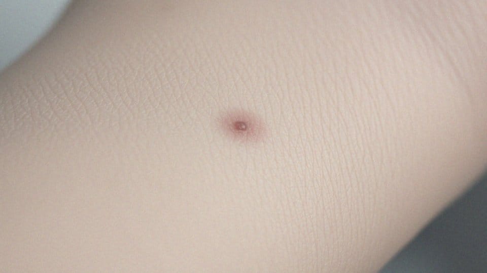 Czy rak kolczystokomórkowy może objawiać się swędzeniem?
